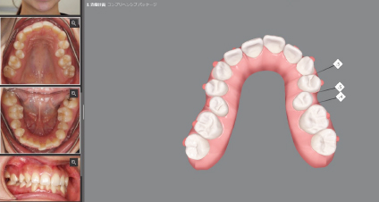 術前のクリンチェック（治療計画）